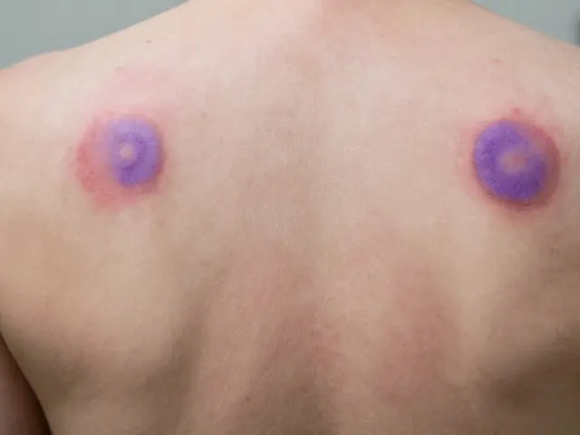 Masážní baňkování: Jak funguje, kde se aplikuje a na co pomáhá